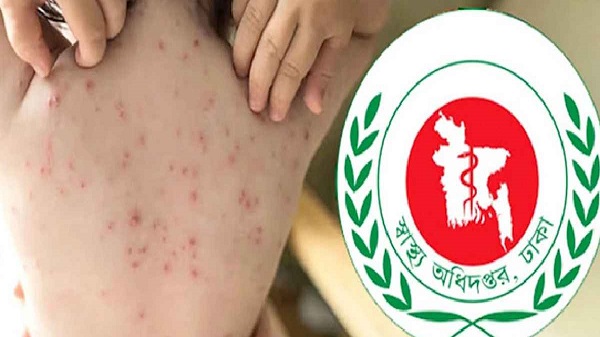 হামের উপসর্গ নিয়ে আরও ১০ শিশুর মৃত্যু