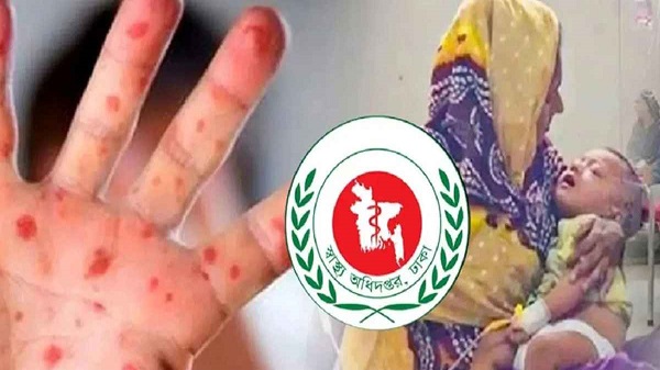 হাম ও হামের উপসর্গ নিয়ে ১৬ জনের মৃত্যু