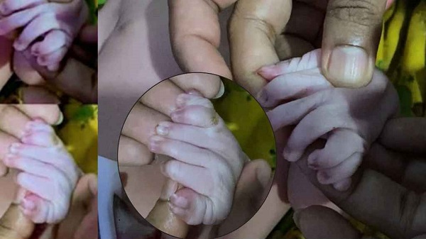 ৩০ আঙুল নিয়ে নবজাতকের জন্ম, নেই জিহ্বাও! 