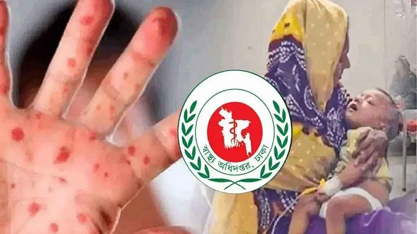 হাম ও হামের উপসর্গ নিয়ে একদিনে আরও ৮ শিশুর মৃত্যু