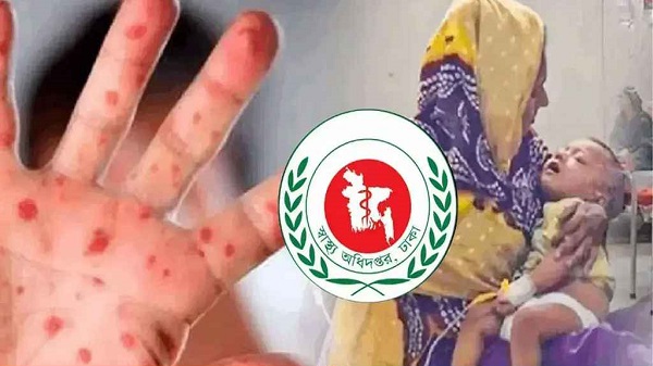 হামের উপসর্গ নিয়ে আরও ৭ শিশুর মৃত্যু